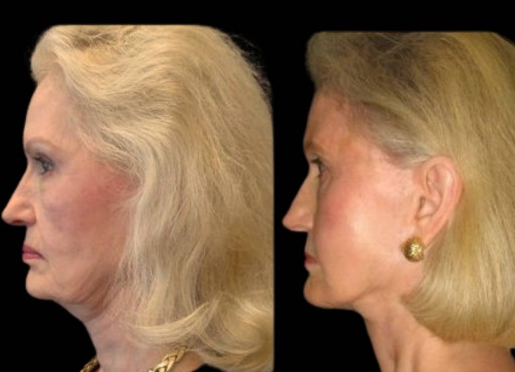 74-year-old-female-facelift-before-and-after-side-view-1693.jpg