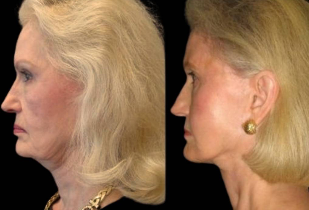 74-year-old-female-facelift-before-and-after-side-view-1693.jpg