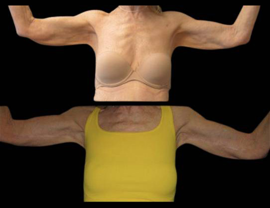 This is a 75-year-old female that has had an arm lift done showing the before and after's side-by-side