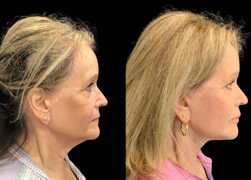 75-year-old-female-model-lift-before-and-after-1.jpg