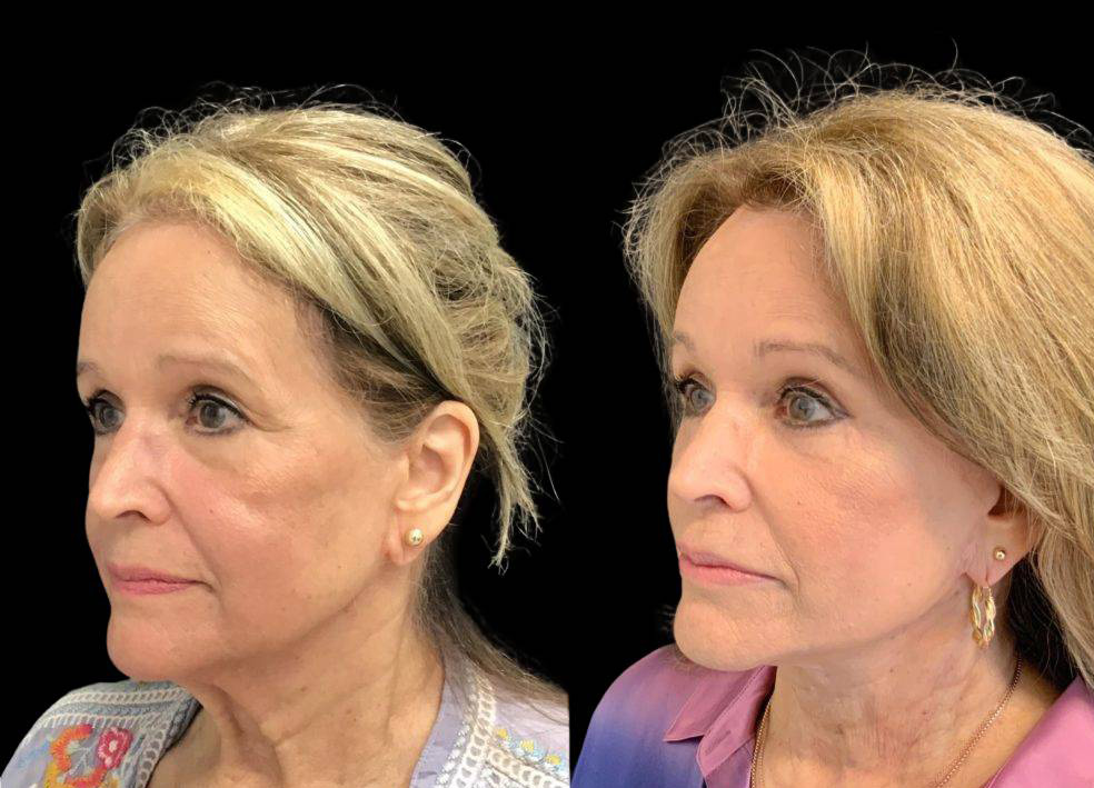 75-year-old-female-model-lift-before-and-after.jpg
