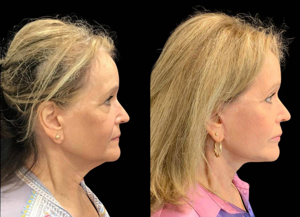 75-year-old-female-model-lift-before-and-after-1.jpg