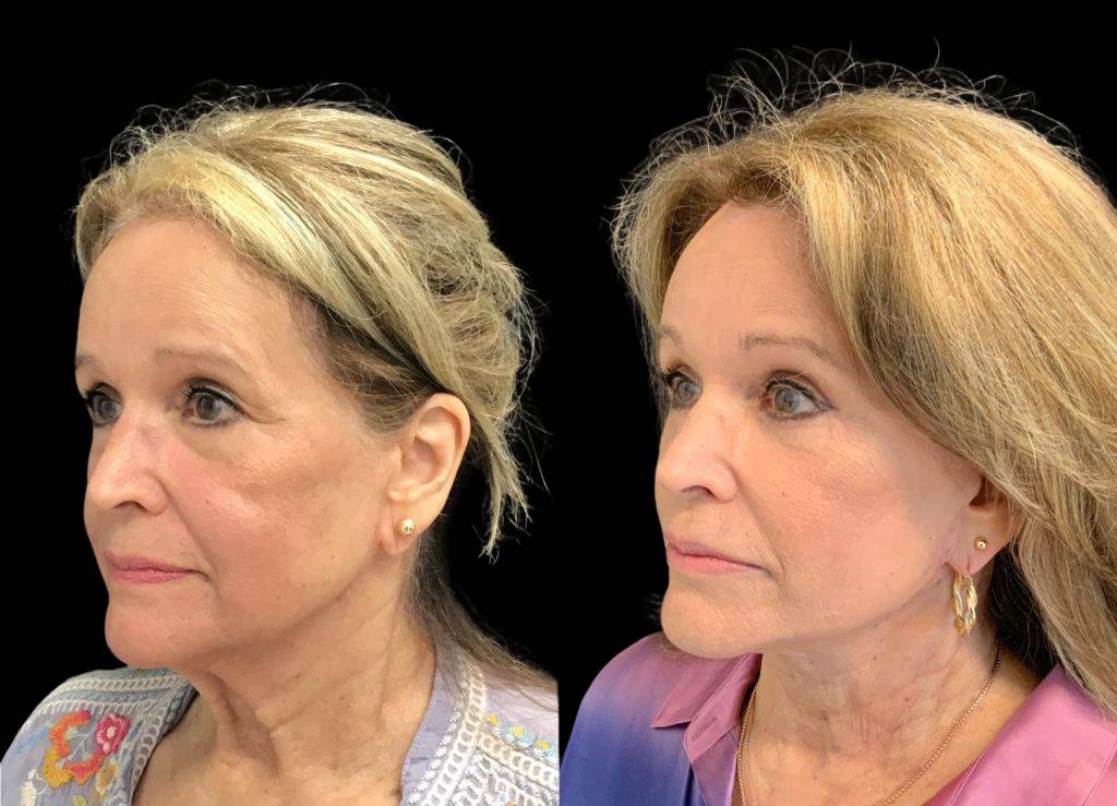 75-year-old-female-model-lift-before-and-after.jpg