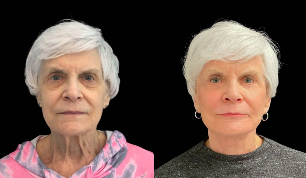 75-year-old-female-upper-and-lower-eyelid-lift-before-and-after-front-view-.jpg