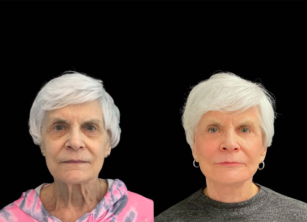 75-year-old-female-upper-and-lower-eyelid-lift-before-and-after-front-view-.jpg