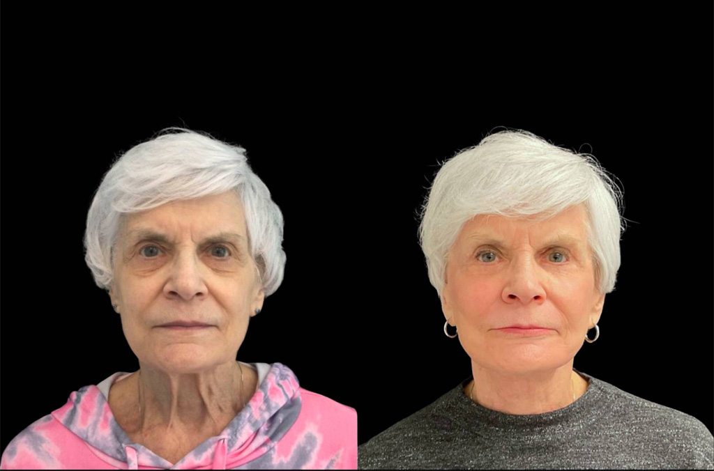 75-year-old-female-upper-and-lower-eyelid-lift-before-and-after-front-view-.jpg