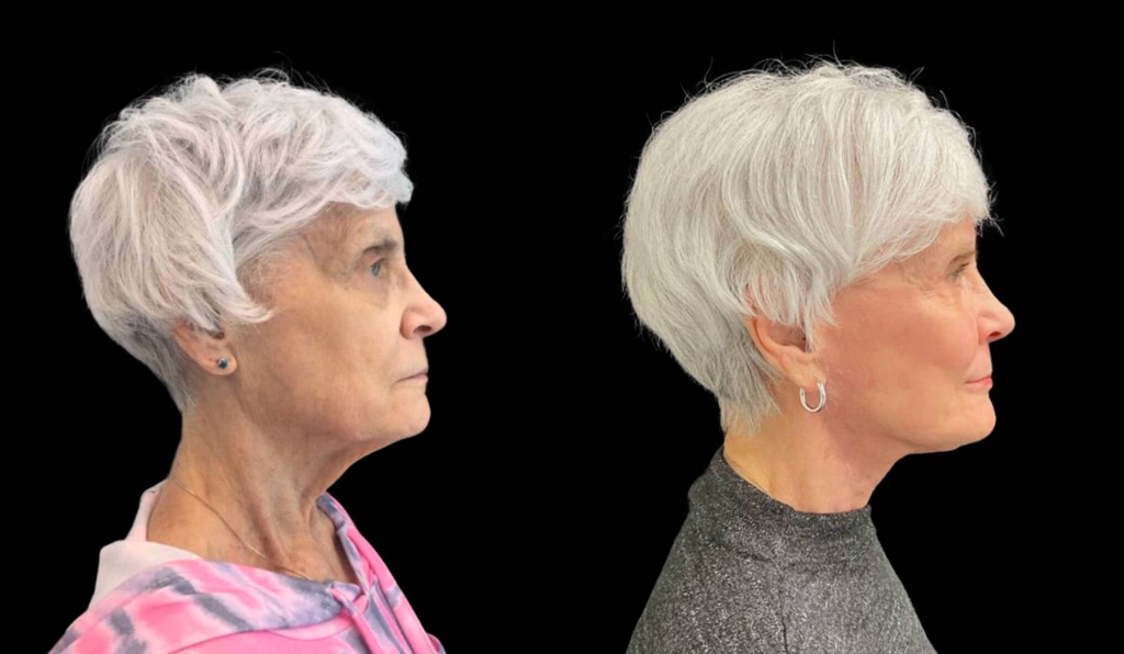 75-year-old-female-upper-and-lower-eyelid-lift-before-and-after-sidet-view-.jpg
