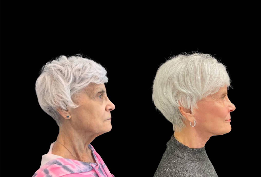 75-year-old-female-upper-and-lower-eyelid-lift-before-and-after-sidet-view-.jpg