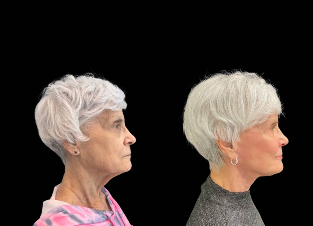 75-year-old-female-upper-and-lower-eyelid-lift-before-and-after-sidet-view-.jpg