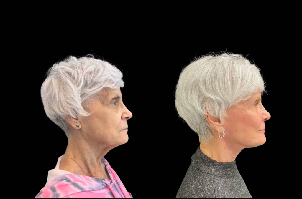 75-year-old-female-upper-and-lower-eyelid-lift-before-and-after-sidet-view-.jpg