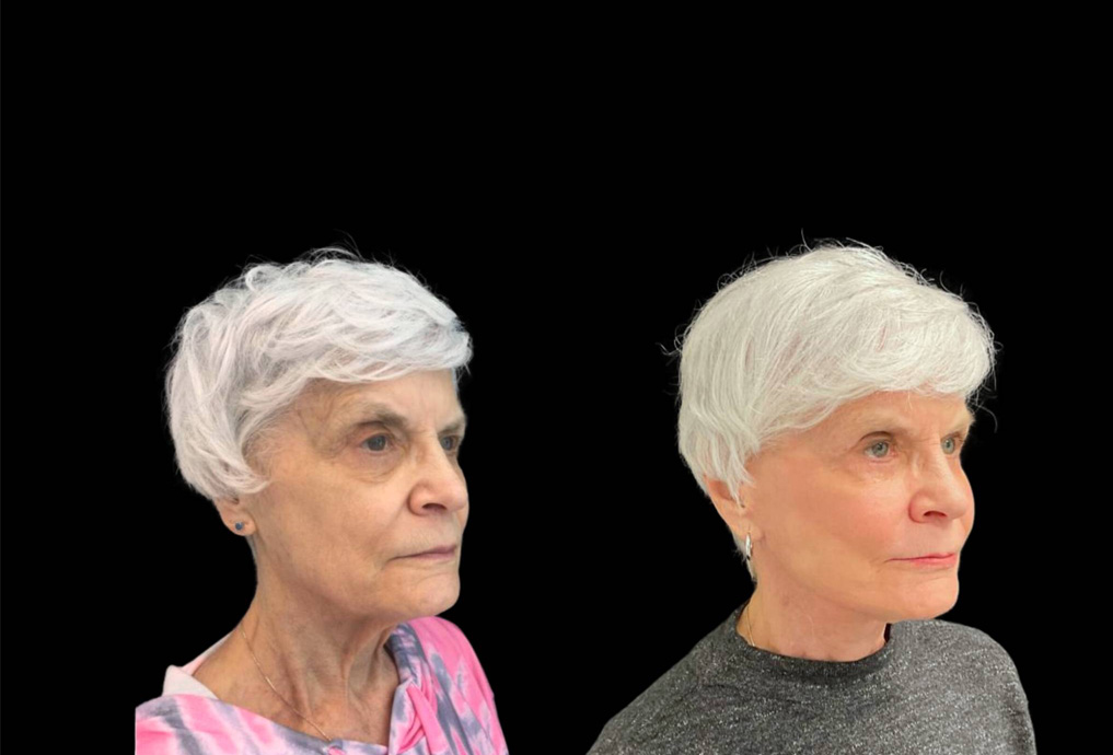 75-year-old-female-upper-and-lower-eyelid-lift-before-and-after-three-quarters-view-.jpg