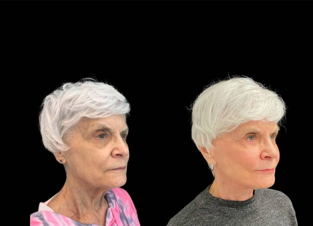 75-year-old-female-upper-and-lower-eyelid-lift-before-and-after-three-quarters-view-.jpg