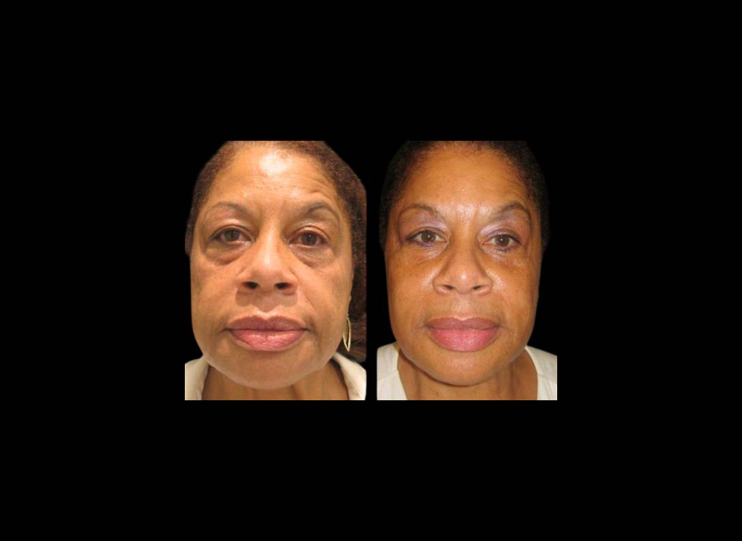 78-year-old-female-dysport-before-and-after.jpg