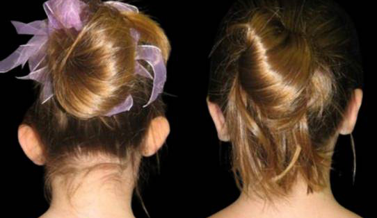 8-year-old-female-ear-pinning-before-and-after-back-view.jpg