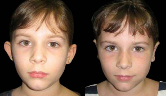 8-year-old-female-ear-pinning-before-and-after-front-view.jpg