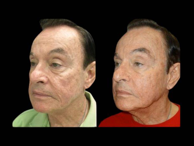 81-year-old-male-non-surgical-cheek-augmentation-before-and-after-2.jpg