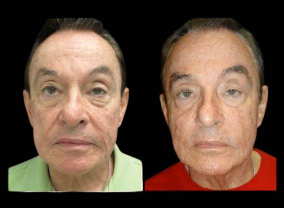 81-year-old-male-non-surgical-cheek-augmentation-before-and-after.jpg