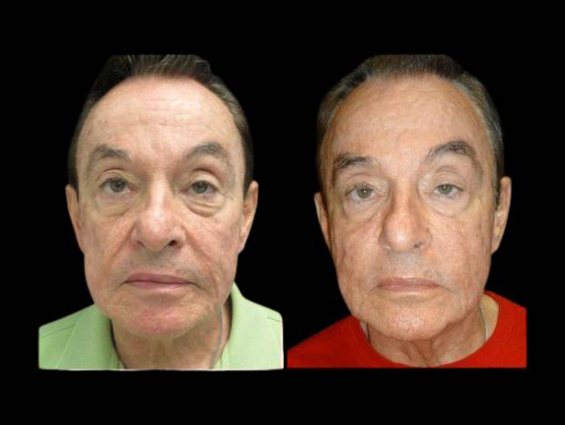 81-year-old-male-non-surgical-cheek-augmentation-before-and-after.jpg