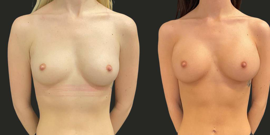 Breast-Augmentation-22-yr-old-female-before-and-after-left-view