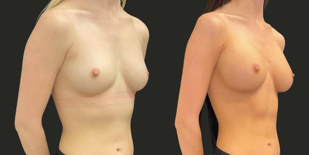 Breast-Augmentation-22-yr-old-female-before-and-after-left-view