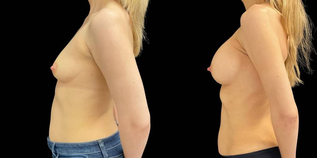 Breast-Augmentation-44-yr-old-female-before-and-after-left-view