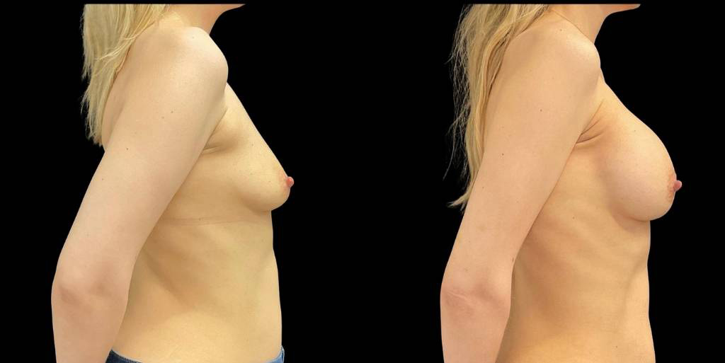 Breast-Augmentation-44-yr-old-female-before-and-after-left-view