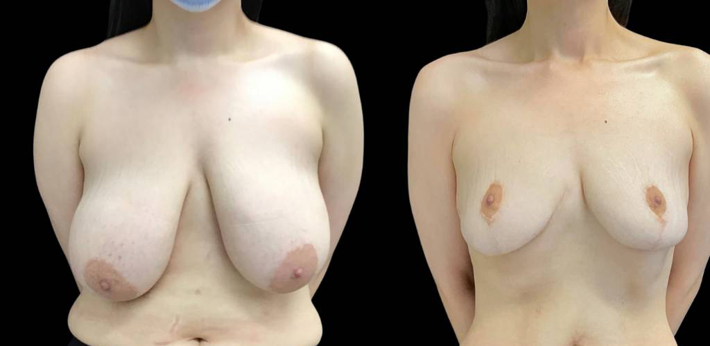 Breast-Reduction-34058.jpg