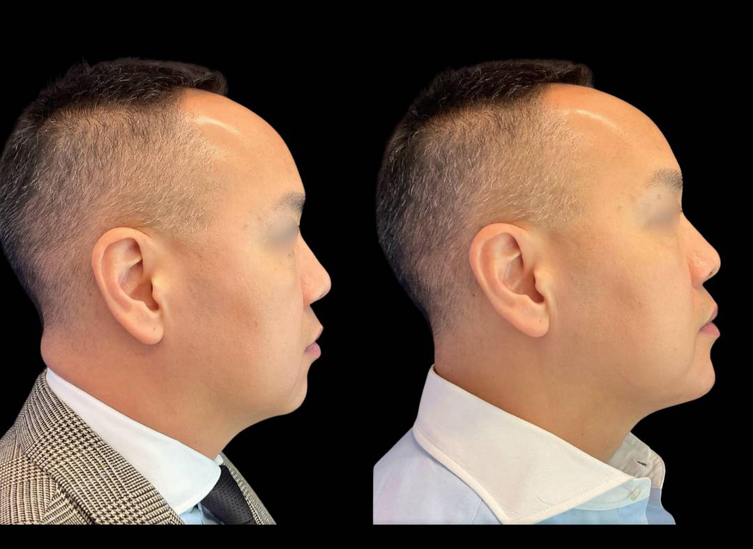 Chin-Filler_male_Before_and_After-1.jpg