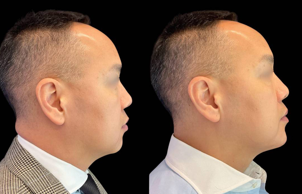 Chin-Filler_male_Before_and_After-1.jpg