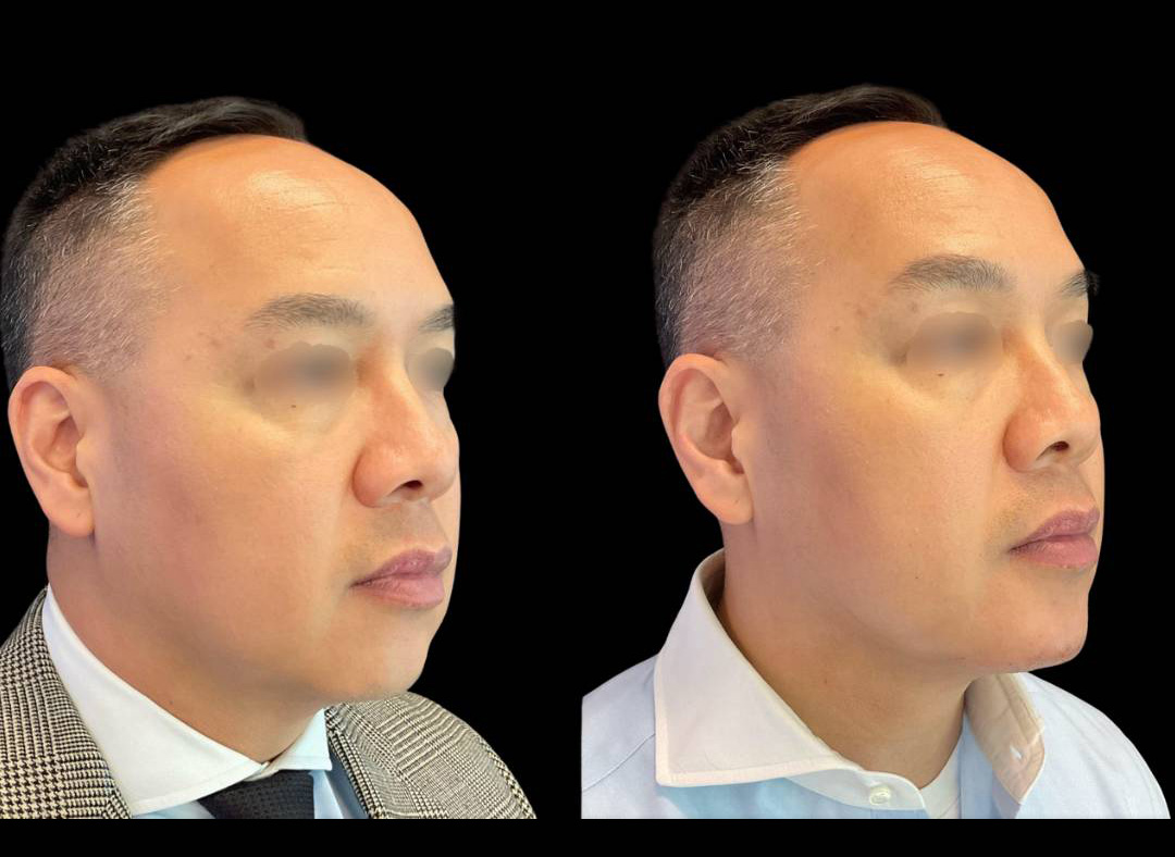 Chin-Filler_male_Before_and_After-3.jpg