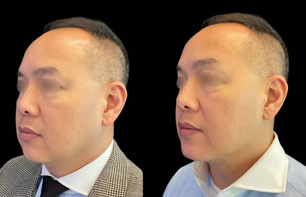 Chin-Filler_male_Before_and_After-3.jpg