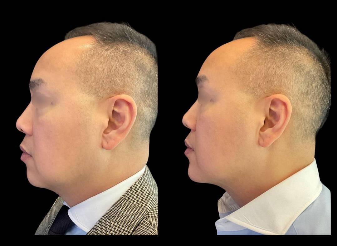 Chin-Filler_male_Before_and_After-4.jpg
