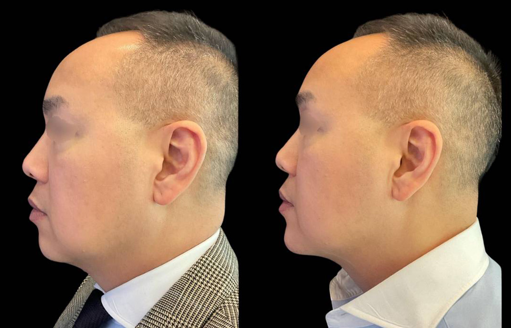 Chin-Filler_male_Before_and_After-4.jpg