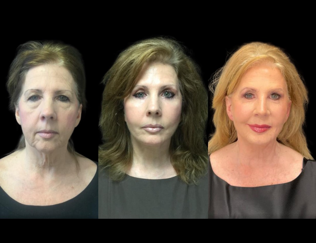 Copy of 38031 rhinoplasty female before and after