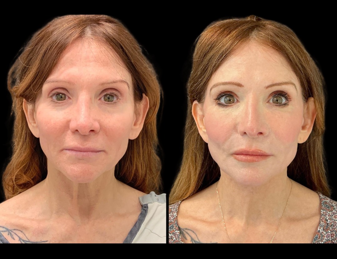 Copy of 5818 Blenheim female before and after – 1