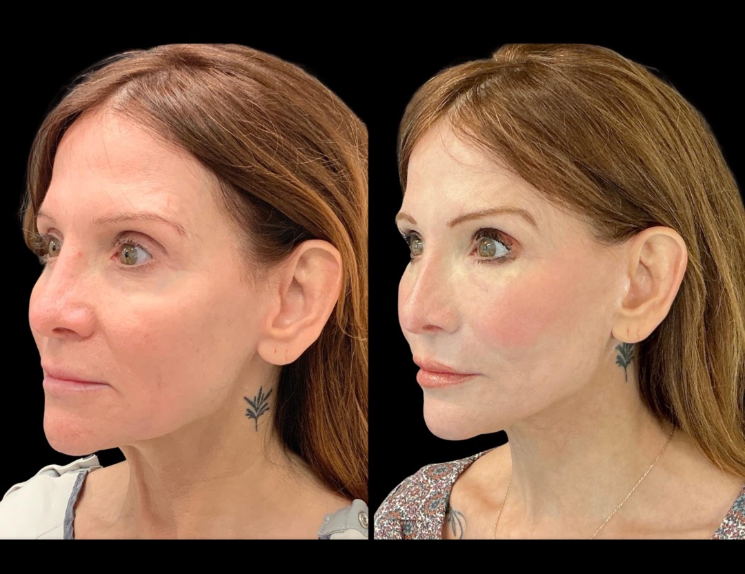 Copy of 5818 Blenheim female before and after – 2 – Copy