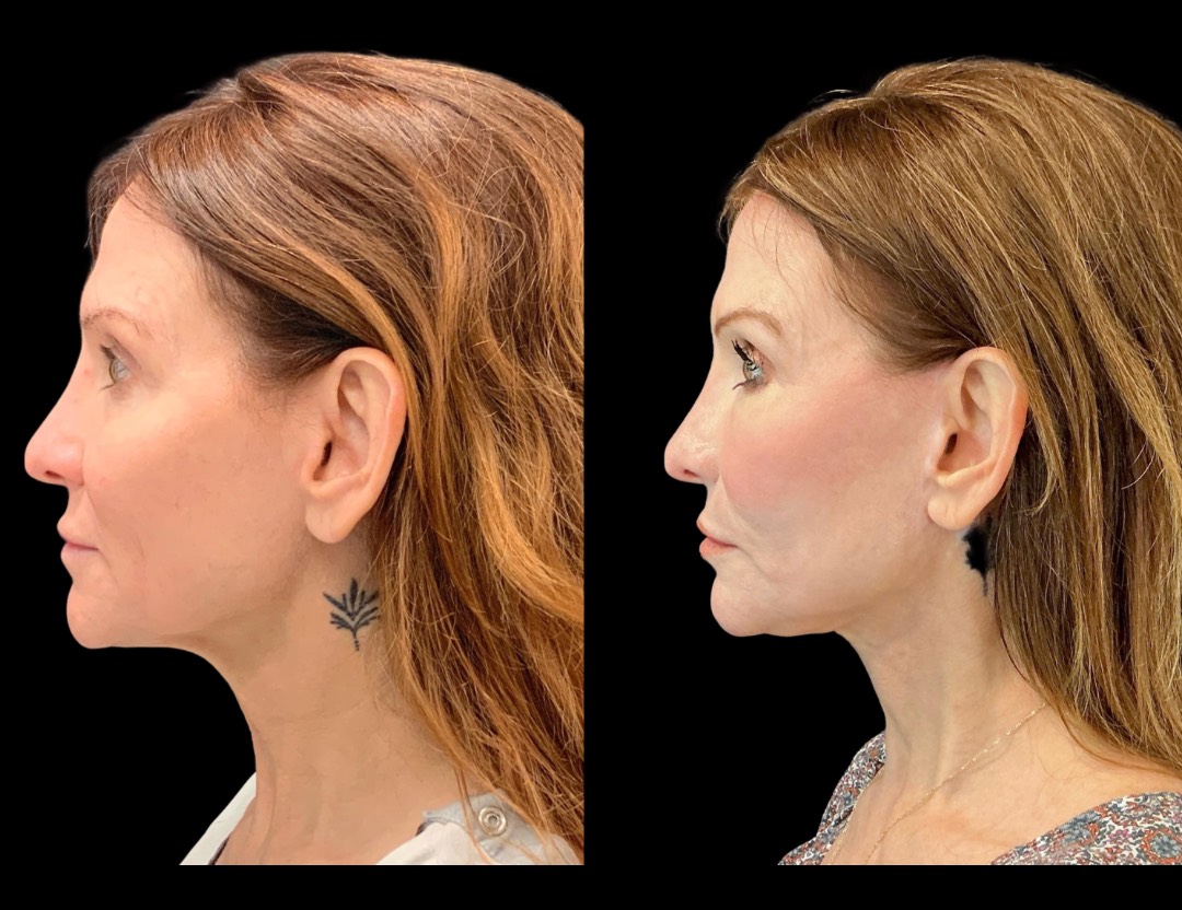 Copy of 5818 Blenheim female before and after – 3