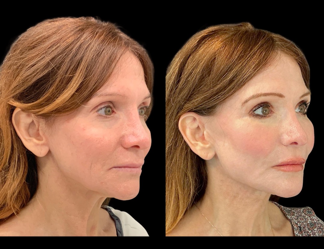 Copy of 5818 Blenheim female before and after – 4