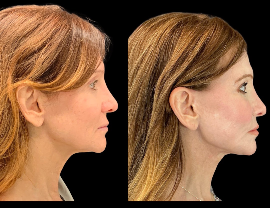 Copy of 5818 Blenheim female before and after – 5