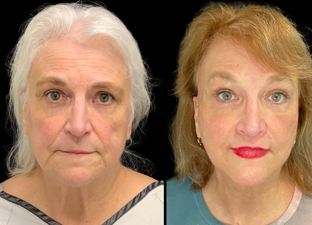Deep-Plane-Facelift-67-yr-old-female-before-and-after-front-view.jpg