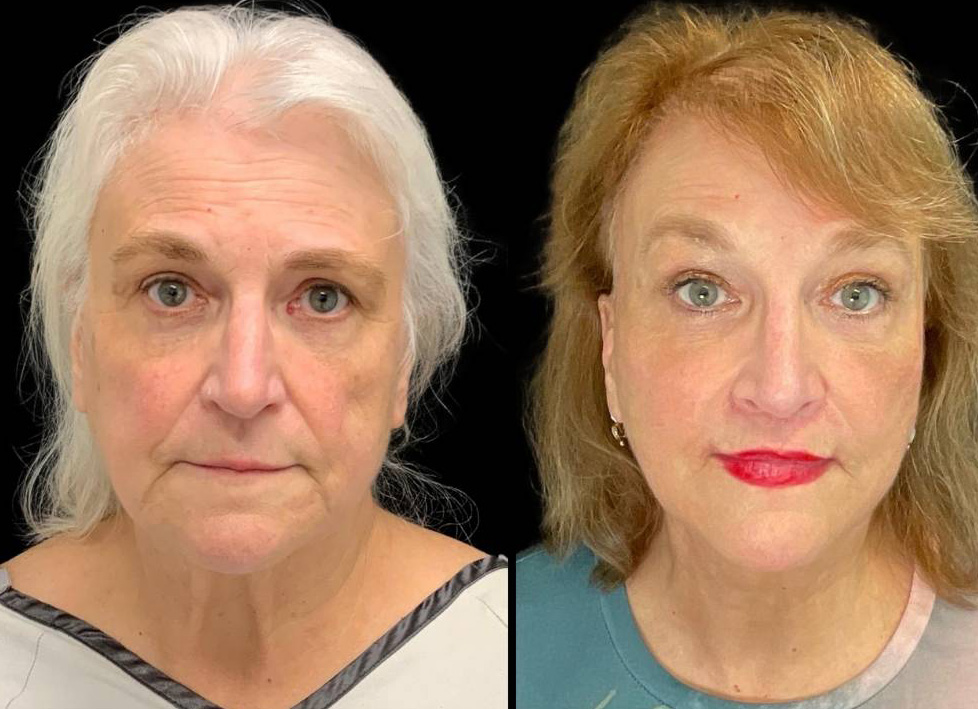 Deep-Plane-Facelift-67-yr-old-female-before-and-after-front-view.jpg