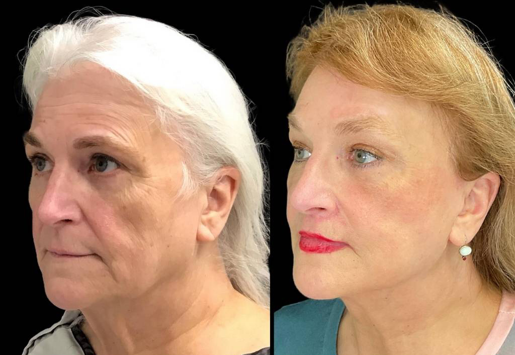 Deep-Plane-Facelift-67-yr-old-female-before-and-after-left-three-quarter-view.jpg