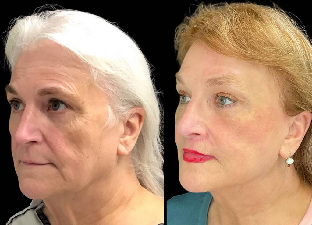 Deep-Plane-Facelift-67-yr-old-female-before-and-after-left-three-quarter-view.jpg