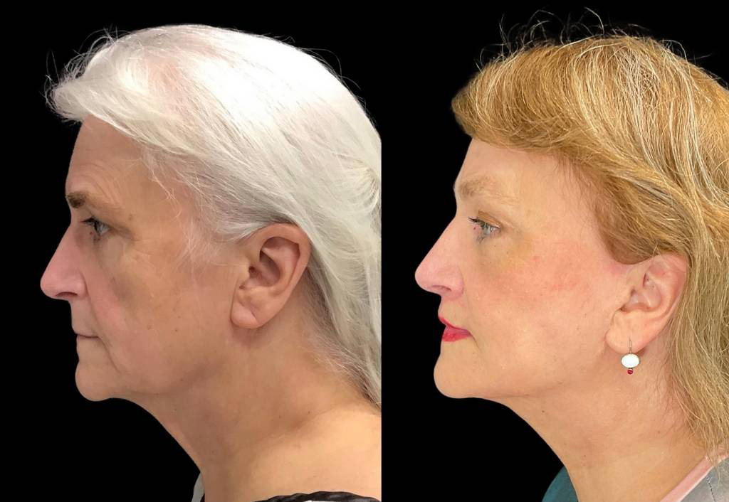Deep-Plane-Facelift-67-yr-old-female-before-and-after-left-view.jpg