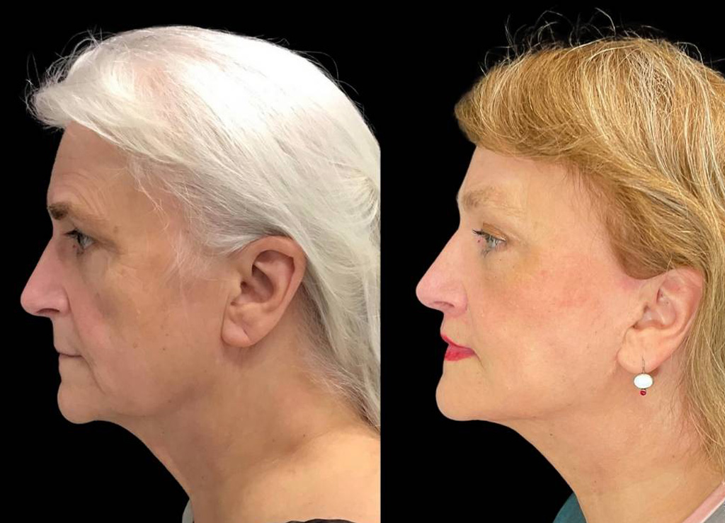 Deep-Plane-Facelift-67-yr-old-female-before-and-after-left-view.jpg
