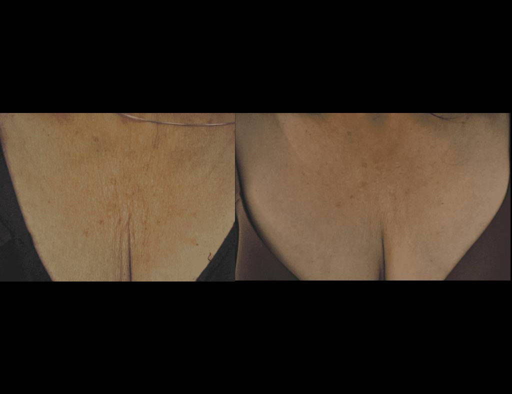 Exilis-Ultra-360™-Before-and-After-Photos-2.jpg