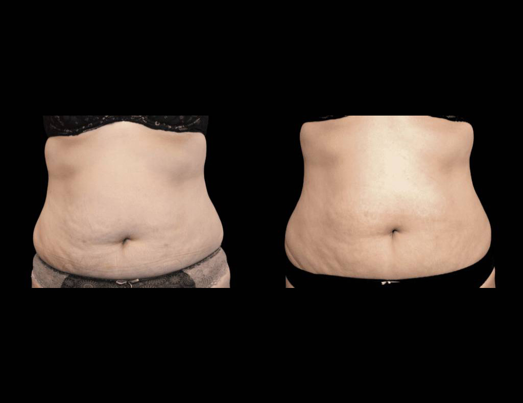 Exilis-Ultra-360™-Before-and-After-Photos-3.jpg