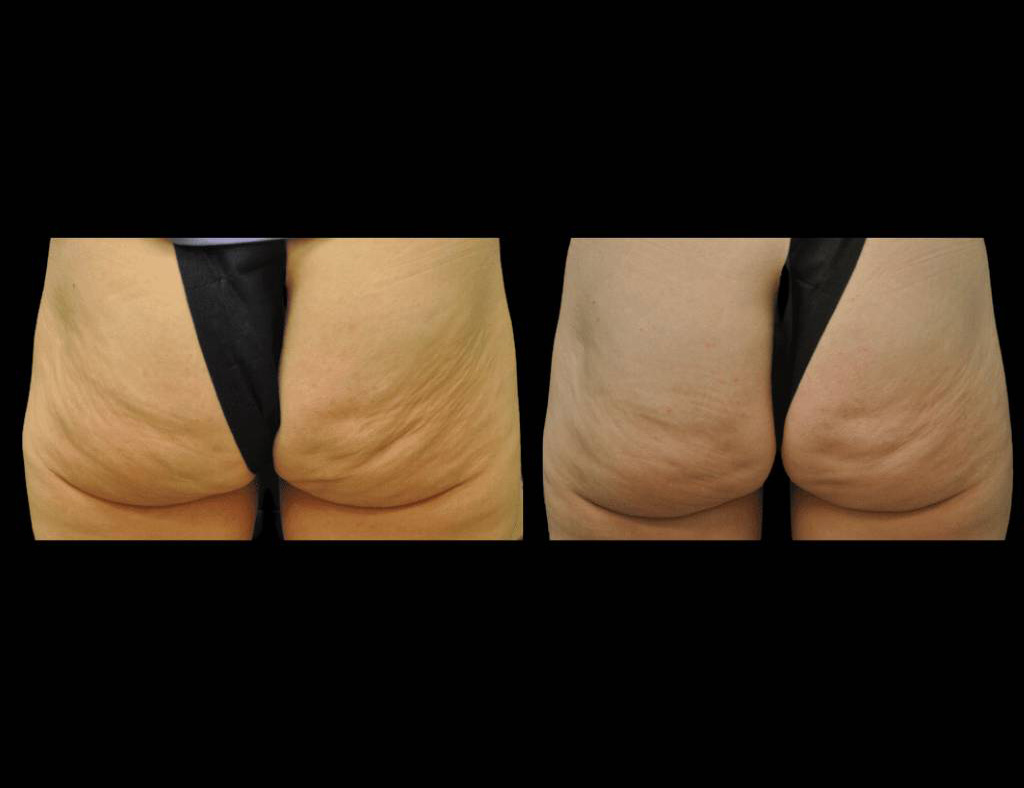 Exilis-Ultra-360™-Before-and-After-Photos-4.jpg