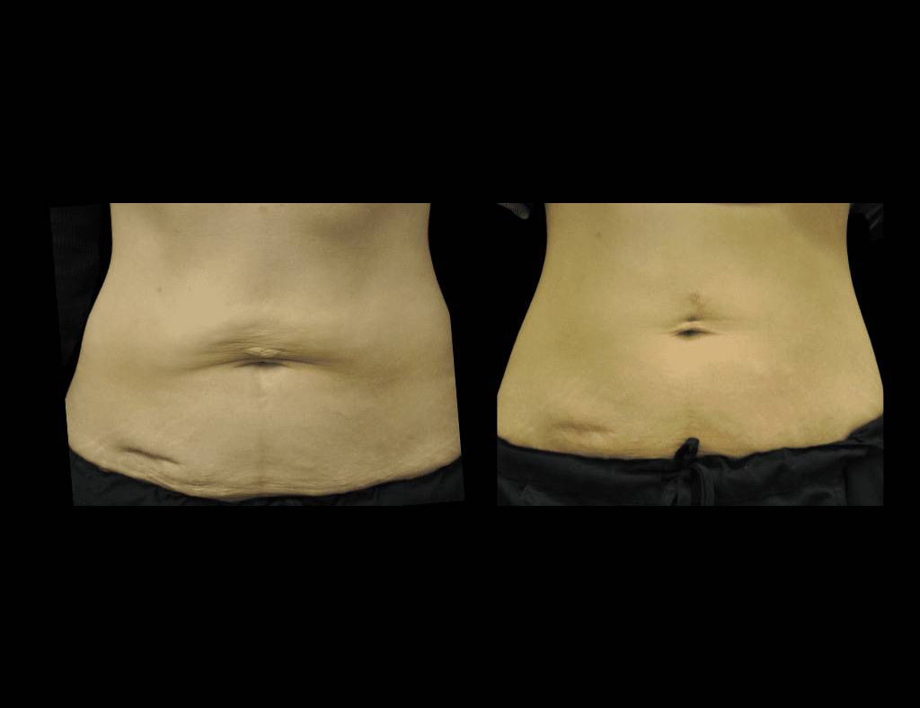 Exilis-Ultra-360™-Before-and-After-Photos-5.jpg