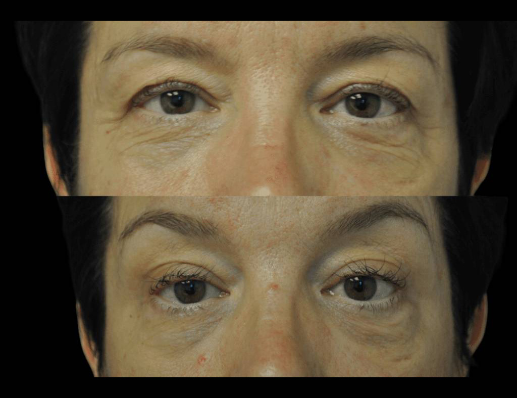 Exilis-Ultra-360™-Before-and-After-Photos-male-eyes.jpg